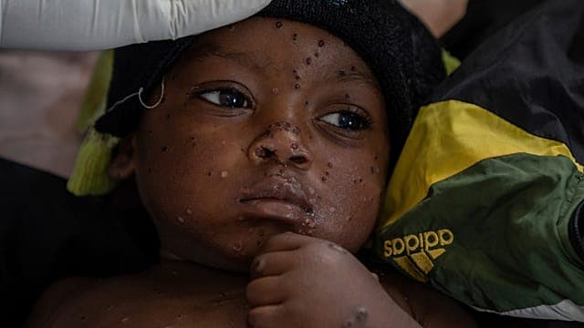 Guinée-Bissau : première épidémie de mpox, les enfants touchés principalement